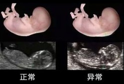 产检nf是什么,孕期nf检查是什么检查