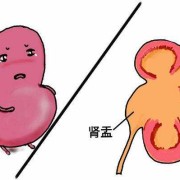 36周孕妇肾积水怎么办,孕36周胎儿肾积水怎么办
