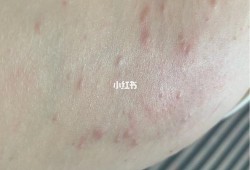 孕期怎么会得湿疹（孕期怎么会得湿疹呢）
