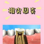 孕期根尖炎（孕期根尖炎疼怎么缓解）