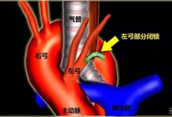 主动脉弓是什么意思,胎儿双主动脉弓能生吗?