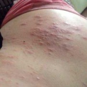 怀孕了得荨麻疹怎么办,孕期荨麻疹症状图片大全