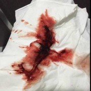 着床出血是怎么回事,孕期着床出血会持续多久