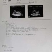 孕期两个月出血（怀孕两个月上大号流血是什么原因）