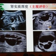 胎儿肾盂分离敢生吗（肾盆分离对胎儿有没有影响）