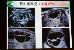 胎儿肾盂分离敢生吗（肾盆分离对胎儿有没有影响）