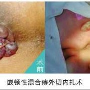 孕期痔疮能自愈吗（内外混合痔能自愈吗）