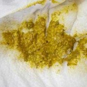 大便特别黏是怎么回事,孕期大便很黏很难解下来怎么办?