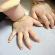 胎儿头变形（宝宝手镯变形如何弄圆）