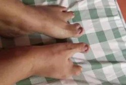 胎儿裂足（胎儿裂足图片）