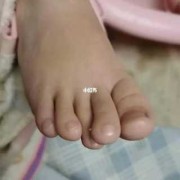 胎儿多脚趾（孩子脚趾遗传爸爸还是妈妈）
