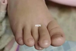 胎儿多脚趾（孩子脚趾遗传爸爸还是妈妈）