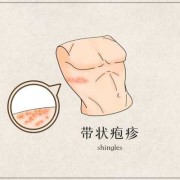 带状疱疹会对孕妇中的胎儿造成影响吗,孕期疱疹病毒感染