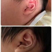 胎儿耳廓（胎儿耳廓形态异常难道就是畸形吗）