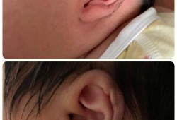 胎儿耳廓（胎儿耳廓形态异常难道就是畸形吗）