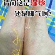 孕晚期手脚痒怎么回事？是不是湿疹啊,孕期手脚湿疹太痒怎么治疗