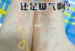 孕晚期手脚痒怎么回事？是不是湿疹啊,孕期手脚湿疹太痒怎么治疗