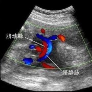 胎儿只有一根脐带（单脐带动脉是什么）