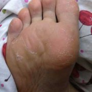 孕期脚出汗（孕期脚出汗多是什么原因怎么办）