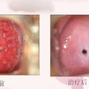怀孕期间宫颈炎症状（宫颈炎早期症状有哪些）