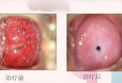 怀孕期间宫颈炎症状（宫颈炎早期症状有哪些）