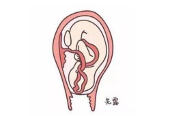 胎儿脐带短的危害（胎儿脐带短的危害有哪些）