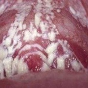 孕期念珠菌（怀孕得了霉菌怎么办）