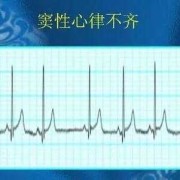 胎儿窦性心律什么意思（胎儿窦性心律什么意思1:1是什么意思）