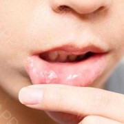孕期起口疮（孕期起口疮怎么办）