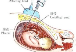 胎儿脐带血染色体检查（胎儿脐带血染色体检查多久出结果）