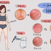 孕期乳晕长湿疹怎么办（孕期乳晕长湿疹怎么办啊）