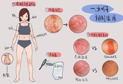 孕期乳晕长湿疹怎么办（孕期乳晕长湿疹怎么办啊）