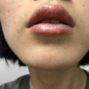 孕期口唇疱疹（孕期口唇疱疹怎么治疗）