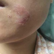 产妇脸上起皮干痒怎么办,孕期脸很干怎么办