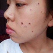 孕期可以点痣吗（孕期可以点痣吗脸上）