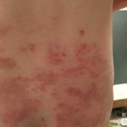 孕妇身上起疹子怎么回事,孕期长湿疹是什么症状图片