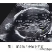 脑室宽对胎儿有何影响（脑室宽对胎儿有影响吗）