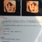 12周胎儿nt（12周胎儿nt值正常范围）