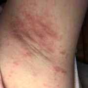孕期腋下痒（孕期腋下痒怎么回事）