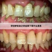 孕妇的的牙齿掉了怎么办,孕期掉牙齿有什么预兆