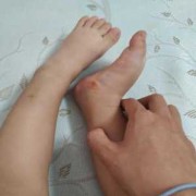 为什么孩子的脚比同龄人的脚偏大了这么多,胎儿手脚畸形的原因有哪些