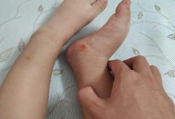 为什么孩子的脚比同龄人的脚偏大了这么多,胎儿手脚畸形的原因有哪些