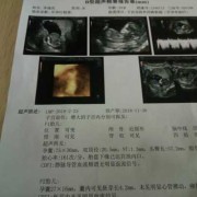 4个月胎儿胃泡多大,胎儿胃泡不显示严重吗怎么办