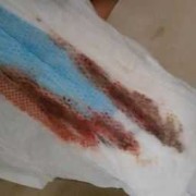 胎儿着床出血（着床出血会有血块吗）