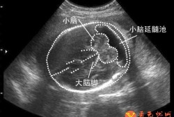 胎儿小脑偏小（孕24周胎儿小脑横径是怎么回事呢？医生也没有说有什么问题）