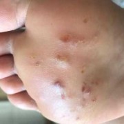 孕期脚长湿疹怎么办（脚底长湿疹怎么治疗）