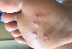 孕期脚长湿疹怎么办（脚底长湿疹怎么治疗）