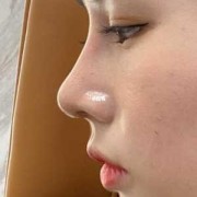 彭体隆鼻+耳软骨鼻尖一个月鼻头很硬正常么,孕期鼻子变硬怎么回事