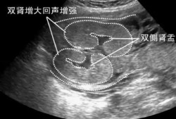 胎儿双侧肾盂未见分离（胎儿双侧肾盂未见分离是什么意思）