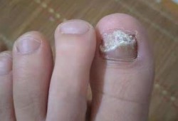 灰指甲怎么能治好,孕期能治疗灰指甲吗